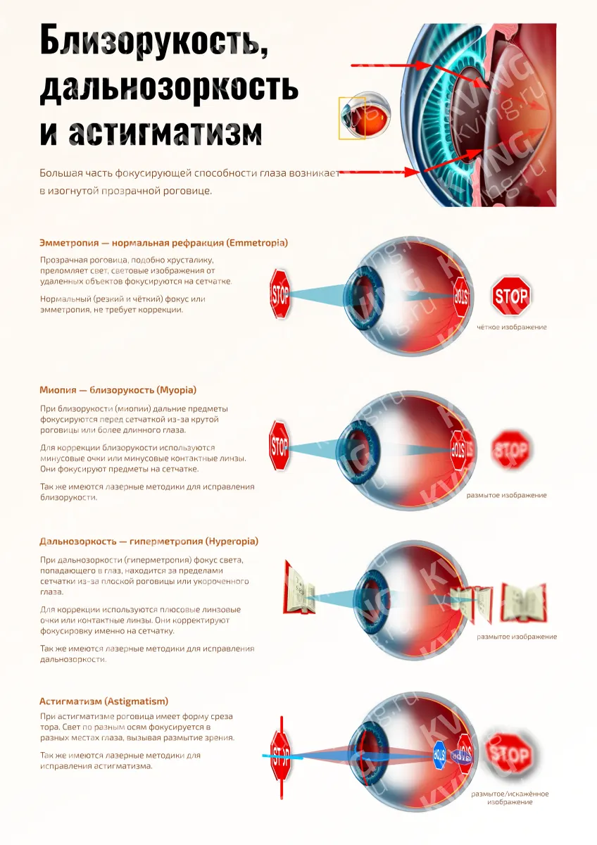 Близорукость, дальнозоркость и астигматизм — медицинский плакат по офтальмологии
