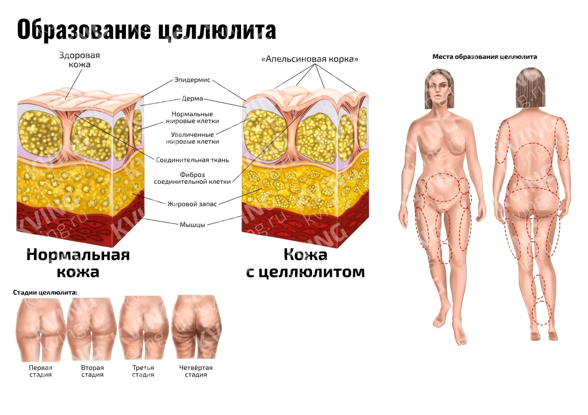 Образование целлюлита — медицинский плакат по косметологии и массажу