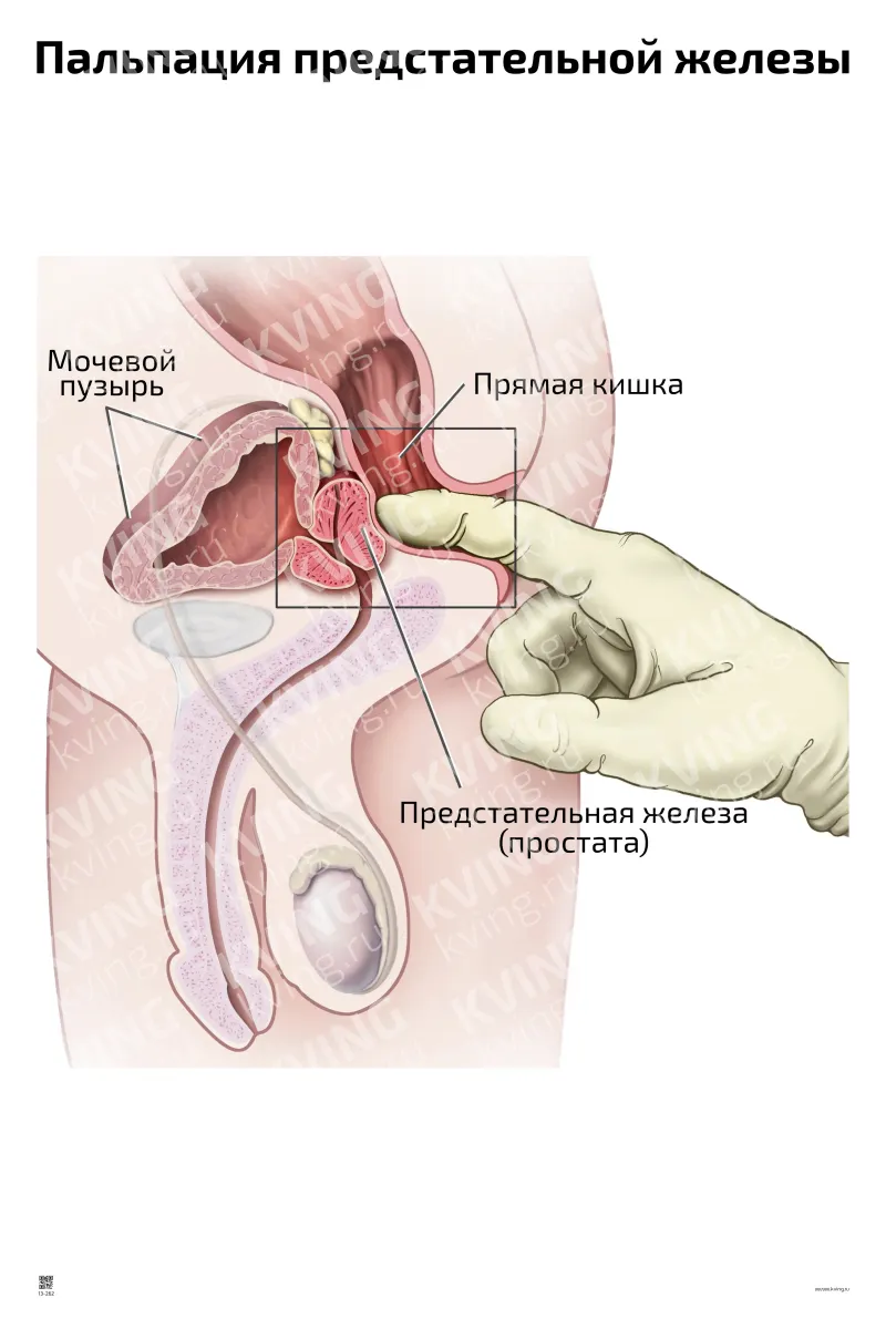 Пальпация предстательной железы — медицинский плакат
