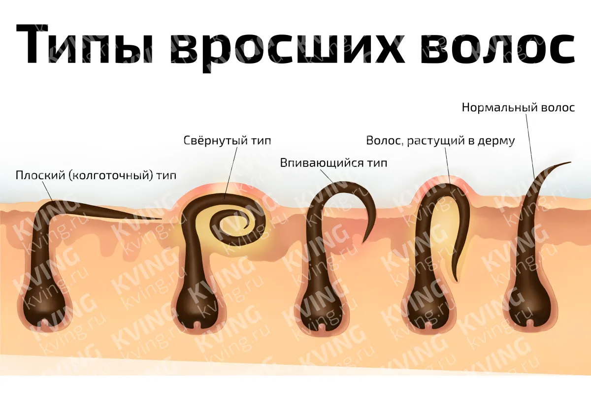 Типы вросших волос — косметологический плакат