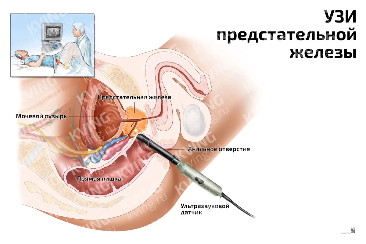 УЗИ  предстательной  железы — медицинский плакат