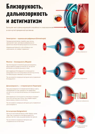 Близорукость, дальнозоркость и астигматизм — медицинский плакат по офтальмологии