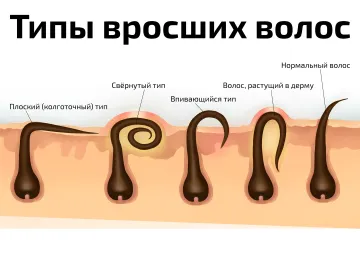 Типы вросших волос — косметологический плакат