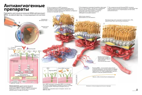 Антиангиогенные препараты для лечения влажной ВМД — медицинский плакат