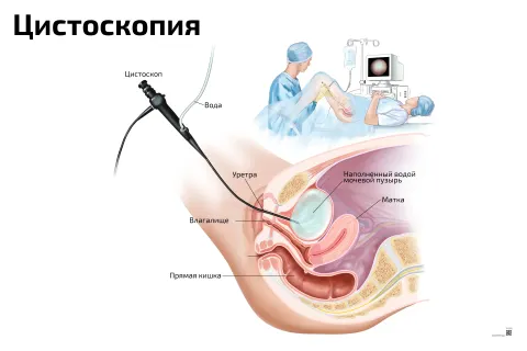 Цистоскопия — медицинский плакат