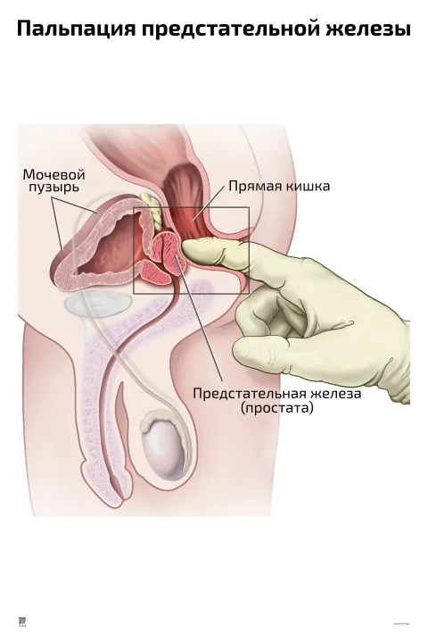 Пальпация предстательной железы — медицинский плакат