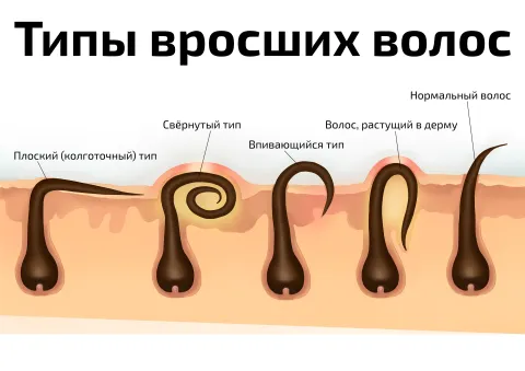 Типы вросших волос — косметологический плакат