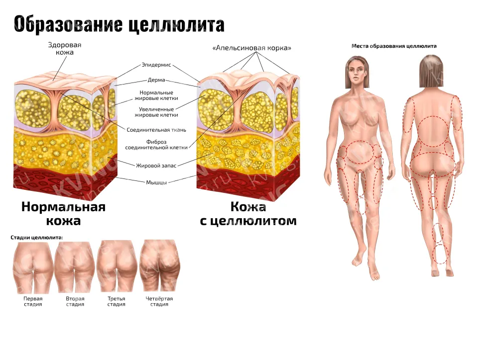 Образование целлюлита — медицинский плакат по косметологии и массажу