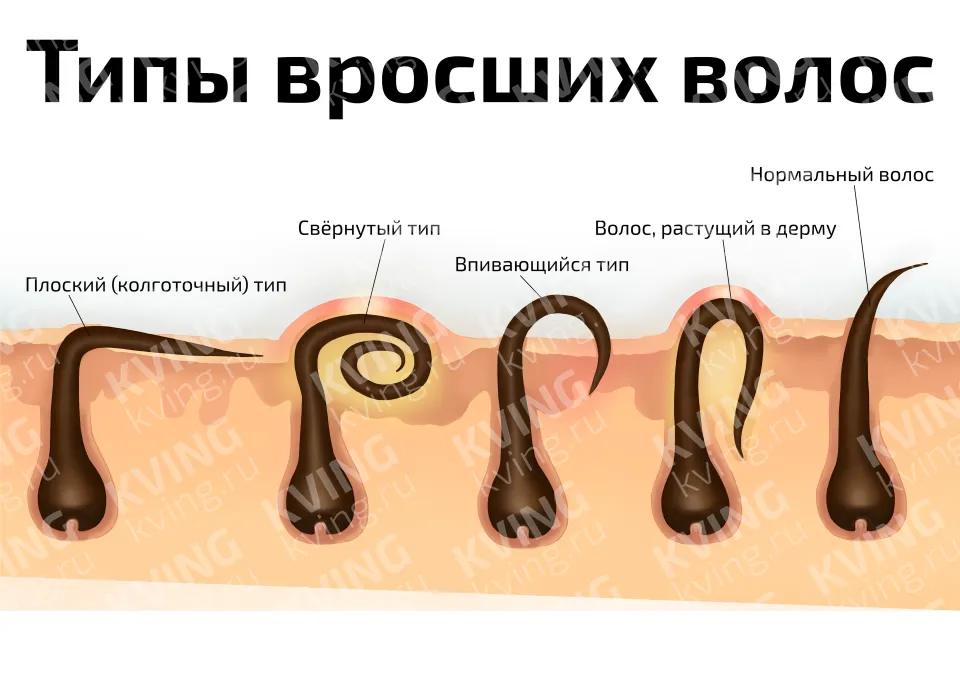 Типы вросших волос — косметологический плакат